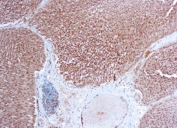 Immunohistochemical staining of Flt-1/VEGFR1  of human FFPE tissue followed by incubation with HRP labeled secondary and development with DAB substrate.