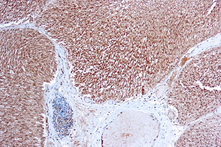 Immunohistochemical staining of Flt-1/VEGFR1  of human FFPE tissue followed by incubation with HRP labeled secondary and development with DAB substrate.