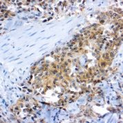 Immunohistochemical staining of Flk-1/KDR/VEGFR2  of human FFPE tissue followed by incubation with HRP labeled secondary and development with DAB substrate.