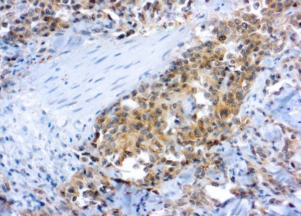 Immunohistochemical staining of Flk-1/KDR/VEGFR2  of human FFPE tissue followed by incubation with HRP labeled secondary and development with DAB substrate.