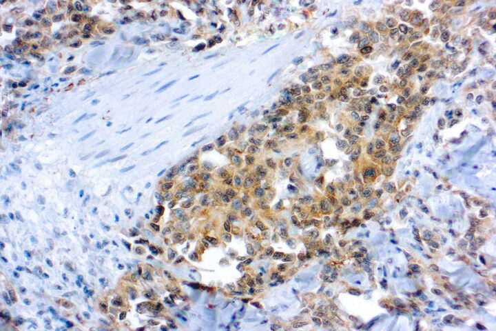 Immunohistochemical staining of Flk-1/KDR/VEGFR2  of human FFPE tissue followed by incubation with HRP labeled secondary and development with DAB substrate.