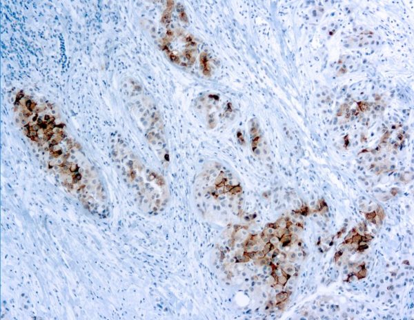 Immunohistochemical staining of Glypican-3  of human FFPE tissue followed by incubation with HRP labeled secondary and development with DAB substrate.