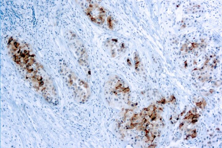 Immunohistochemical staining of Glypican-3  of human FFPE tissue followed by incubation with HRP labeled secondary and development with DAB substrate.