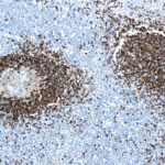 Immunohistochemical staining of Hairy Cell Leukemia  of human FFPE tissue followed by incubation with HRP labeled secondary and development with DAB substrate.