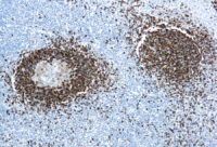 Immunohistochemical staining of Hairy Cell Leukemia  of human FFPE tissue followed by incubation with HRP labeled secondary and development with DAB substrate.