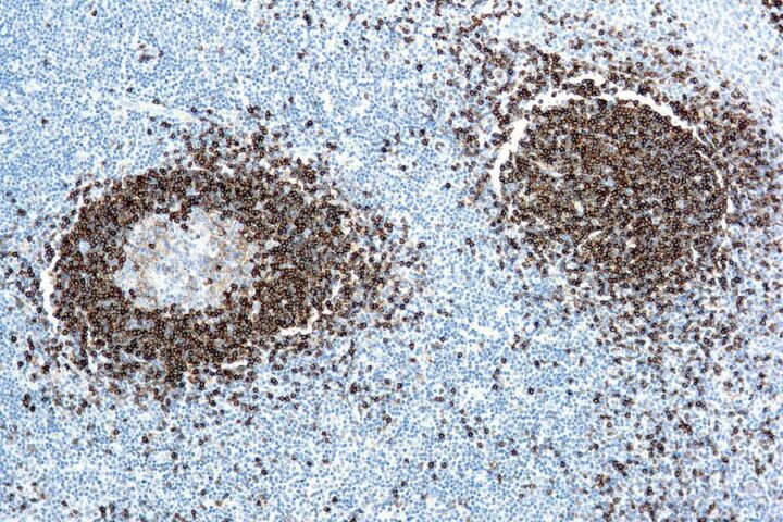 Immunohistochemical staining of Hairy Cell Leukemia  of human FFPE tissue followed by incubation with HRP labeled secondary and development with DAB substrate.