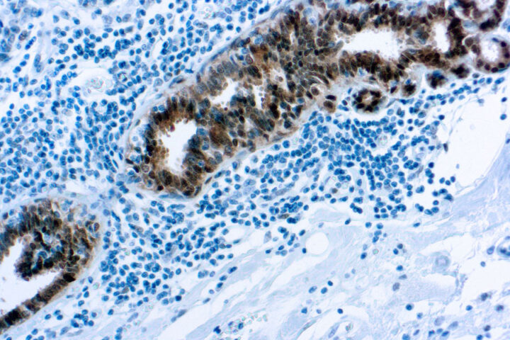 Immunohistochemical staining of Heat Shock Protein 70  of human FFPE tissue followed by incubation with HRP labeled secondary and development with DAB substrate.