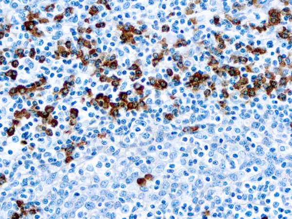 Immunohistochemical staining of IgG  of human FFPE tissue followed by incubation with HRP labeled secondary and development with DAB substrate.