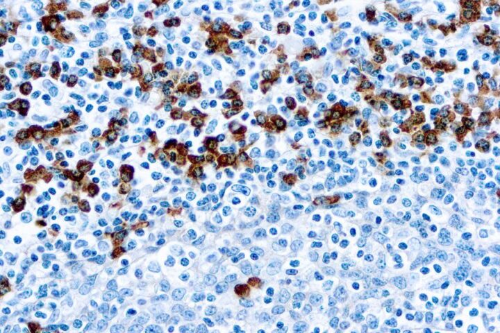 Immunohistochemical staining of IgG  of human FFPE tissue followed by incubation with HRP labeled secondary and development with DAB substrate.