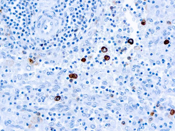 Immunohistochemical staining of IgM  of human FFPE tissue followed by incubation with HRP labeled secondary and development with DAB substrate.
