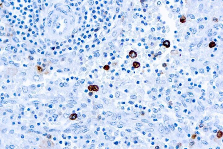 Immunohistochemical staining of IgM  of human FFPE tissue followed by incubation with HRP labeled secondary and development with DAB substrate.