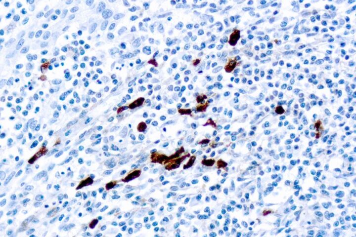 Immunohistochemical staining of IgD  of human FFPE tissue followed by incubation with HRP labeled secondary and development with DAB substrate.