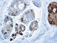 Immunohistochemical staining of GCDFP-15  of human FFPE tissue followed by incubation with HRP labeled secondary and development with DAB substrate.