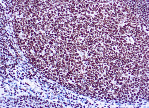 Immunohistochemical staining of Ku  of human FFPE tissue followed by incubation with HRP labeled secondary and development with DAB substrate.