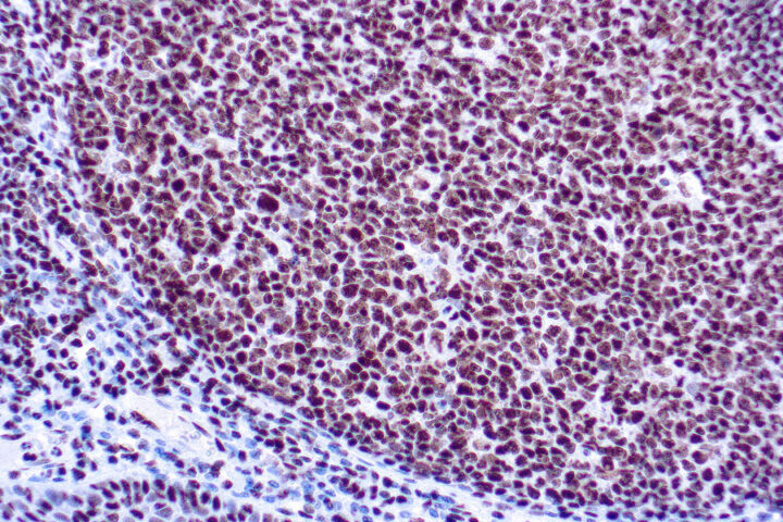 Immunohistochemical staining of Ku  of human FFPE tissue followed by incubation with HRP labeled secondary and development with DAB substrate.