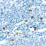 Immunohistochemical staining of Mast Cell Chymase  of human FFPE tissue followed by incubation with HRP labeled secondary and development with DAB substrate.