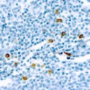 Immunohistochemical staining of Mast Cell Chymase  of human FFPE tissue followed by incubation with HRP labeled secondary and development with DAB substrate.