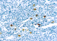 Immunohistochemical staining of Mast Cell Chymase  of human FFPE tissue followed by incubation with HRP labeled secondary and development with DAB substrate.