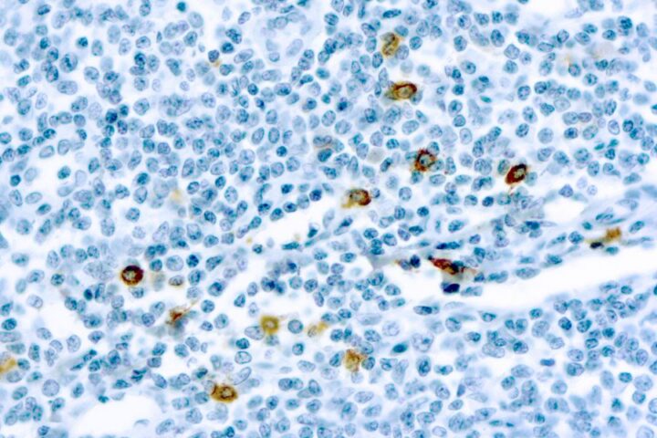 Immunohistochemical staining of Mast Cell Chymase  of human FFPE tissue followed by incubation with HRP labeled secondary and development with DAB substrate.
