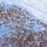 Immunohistochemical staining of Melanoma  of human FFPE tissue followed by incubation with HRP labeled secondary and development with DAB substrate.