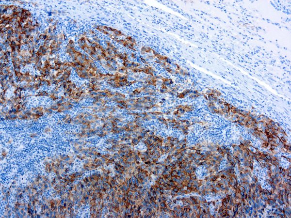 Immunohistochemical staining of Melanoma  of human FFPE tissue followed by incubation with HRP labeled secondary and development with DAB substrate.