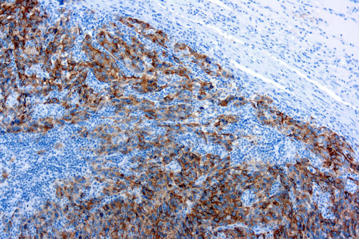 Immunohistochemical staining of Melanoma  of human FFPE tissue followed by incubation with HRP labeled secondary and development with DAB substrate.