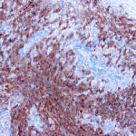 Immunohistochemical staining of Melanoma Cocktail Antibody  of human FFPE tissue followed by incubation with HRP labeled secondary and development with DAB substrate.