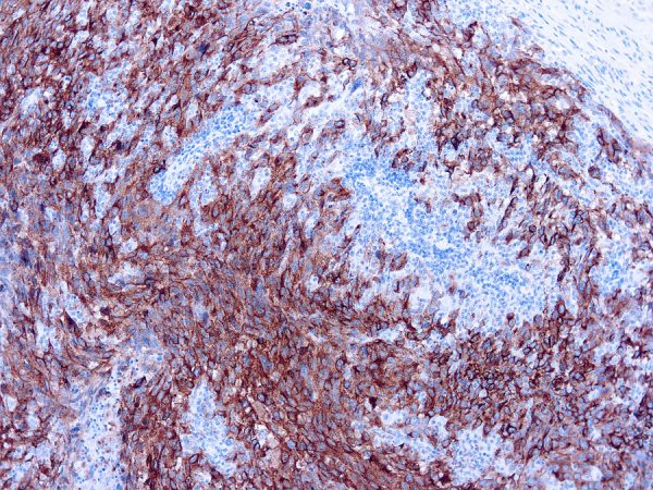 Immunohistochemical staining of Melanoma Cocktail Antibody  of human FFPE tissue followed by incubation with HRP labeled secondary and development with DAB substrate.