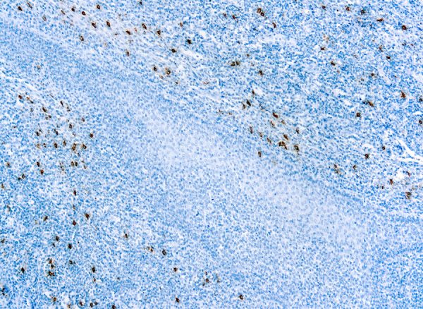 Immunohistochemical staining of Mast Cell Tryptase  of human FFPE tissue followed by incubation with HRP labeled secondary and development with DAB substrate.