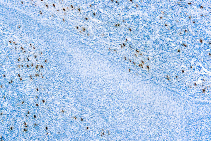 Immunohistochemical staining of Mast Cell Tryptase  of human FFPE tissue followed by incubation with HRP labeled secondary and development with DAB substrate.