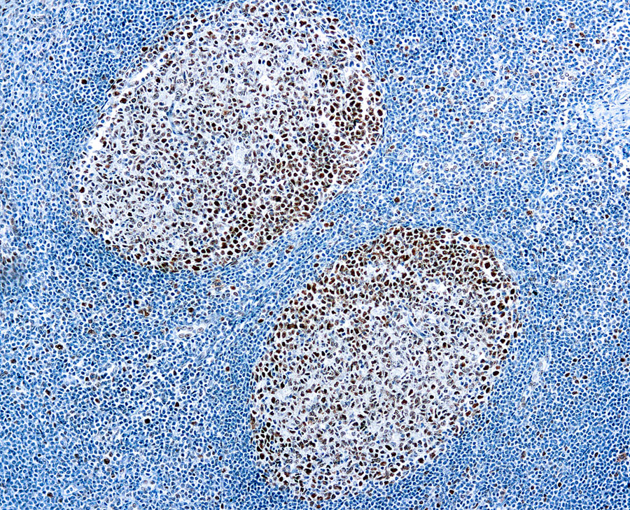 Immunohistochemical staining of Mismatch Repair Protein 2  of human FFPE tissue followed by incubation with HRP labeled secondary and development with DAB substrate.