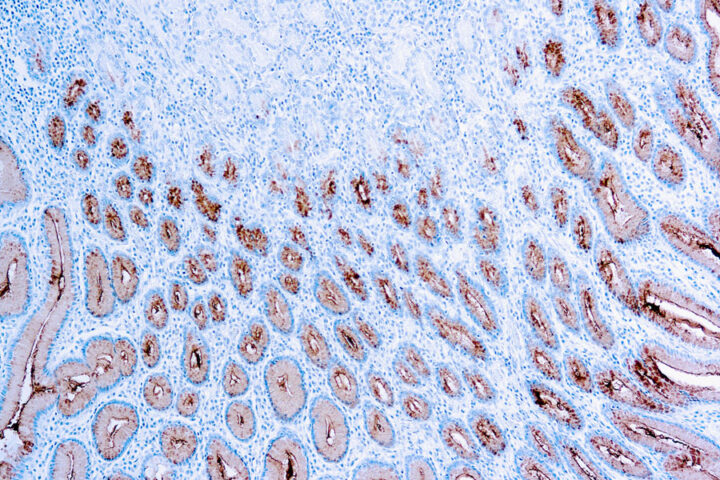 Immunohistochemical staining of Mucin 5AC/Gastric Mucin  of human FFPE tissue followed by incubation with HRP labeled secondary and development with DAB substrate.