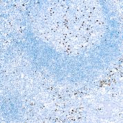 Immunohistochemical staining of MUM1 Protein  of human FFPE tissue followed by incubation with HRP labeled secondary and development with DAB substrate.
