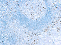 Immunohistochemical staining of MUM1 Protein  of human FFPE tissue followed by incubation with HRP labeled secondary and development with DAB substrate.