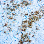 Immunohistochemical staining of Mesothelioma  of human FFPE tissue followed by incubation with HRP labeled secondary and development with DAB substrate.