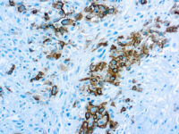 Immunohistochemical staining of Mesothelioma  of human FFPE tissue followed by incubation with HRP labeled secondary and development with DAB substrate.