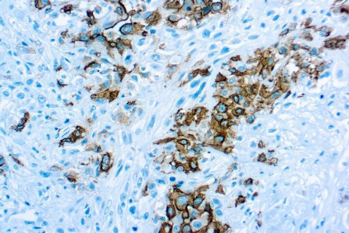 Immunohistochemical staining of Mesothelioma  of human FFPE tissue followed by incubation with HRP labeled secondary and development with DAB substrate.