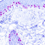 Immunohistochemical staining of Microphthalmia Transcription Factor  of human FFPE tissue followed by incubation with HRP labeled secondary and development with DAB substrate.