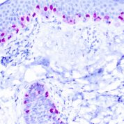 Immunohistochemical staining of Microphthalmia Transcription Factor  of human FFPE tissue followed by incubation with HRP labeled secondary and development with DAB substrate.
