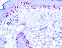 Immunohistochemical staining of Microphthalmia Transcription Factor  of human FFPE tissue followed by incubation with HRP labeled secondary and development with DAB substrate.