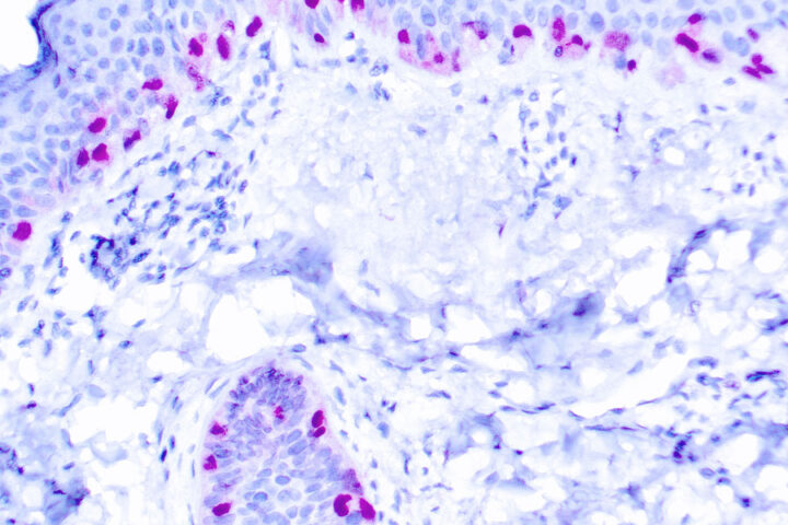 Immunohistochemical staining of Microphthalmia Transcription Factor  of human FFPE tissue followed by incubation with HRP labeled secondary and development with DAB substrate.