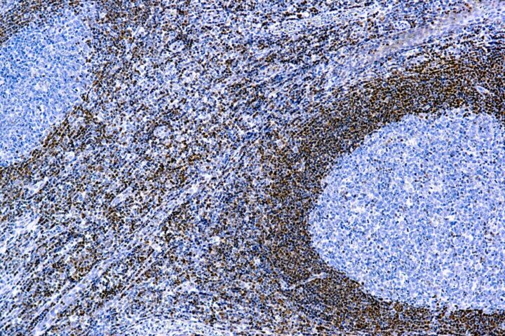 Immunohistochemical staining of Bcl-2 Oncoprotein  of human FFPE tissue followed by incubation with HRP labeled secondary and development with DAB substrate.