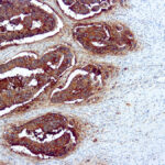 Immunohistochemical staining of Carcinoembryonic  of human FFPE tissue followed by incubation with HRP labeled secondary and development with DAB substrate.