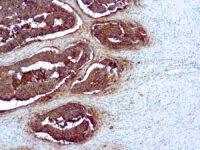 Immunohistochemical staining of Carcinoembryonic  of human FFPE tissue followed by incubation with HRP labeled secondary and development with DAB substrate.