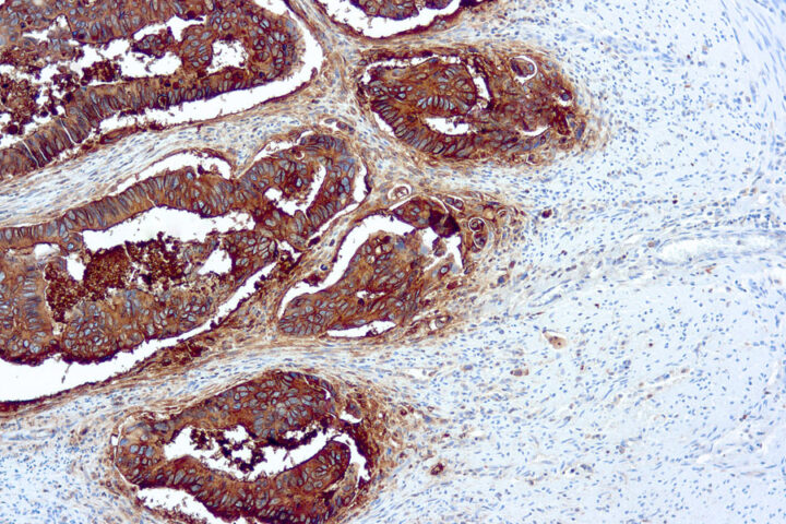 Immunohistochemical staining of Carcinoembryonic  of human FFPE tissue followed by incubation with HRP labeled secondary and development with DAB substrate.