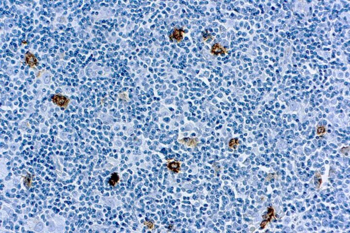 Immunohistochemical staining of CD15/Granulocyte Associated  of human FFPE tissue followed by incubation with HRP labeled secondary and development with DAB substrate.