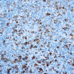 Immunohistochemical staining of CD30/Ki-1  of human FFPE tissue followed by incubation with HRP labeled secondary and development with DAB substrate.