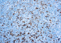 Immunohistochemical staining of CD30/Ki-1  of human FFPE tissue followed by incubation with HRP labeled secondary and development with DAB substrate.