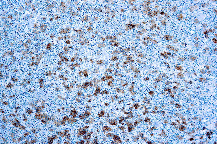 Immunohistochemical staining of CD30/Ki-1  of human FFPE tissue followed by incubation with HRP labeled secondary and development with DAB substrate.