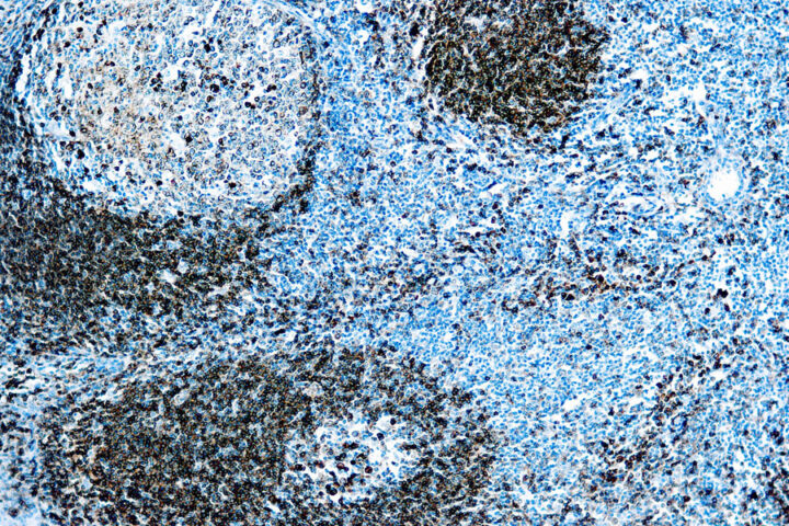 Immunohistochemical staining of CD79a  of human FFPE tissue followed by incubation with HRP labeled secondary and development with DAB substrate.